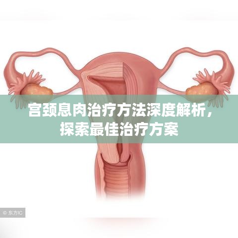 宫颈息肉治疗方法深度解析，探索最佳治疗方案